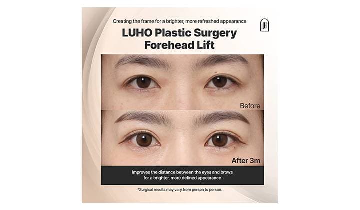 A Brighter, More Open Look: Forehead Lift in Gangnam