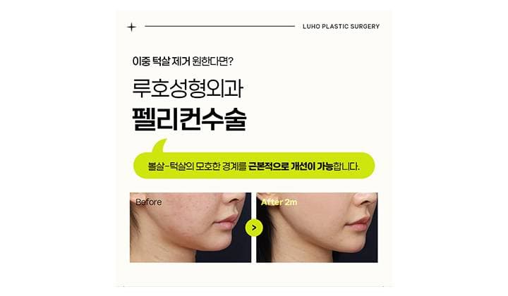 신사역 펠리컨 수술로 이중 턱살 제거한 후기