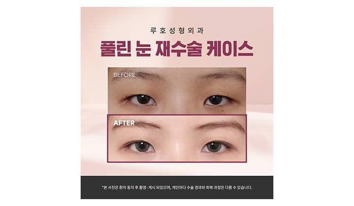 신사역 쌍꺼풀 눈 재수술, 풀린 라인을 선명하게