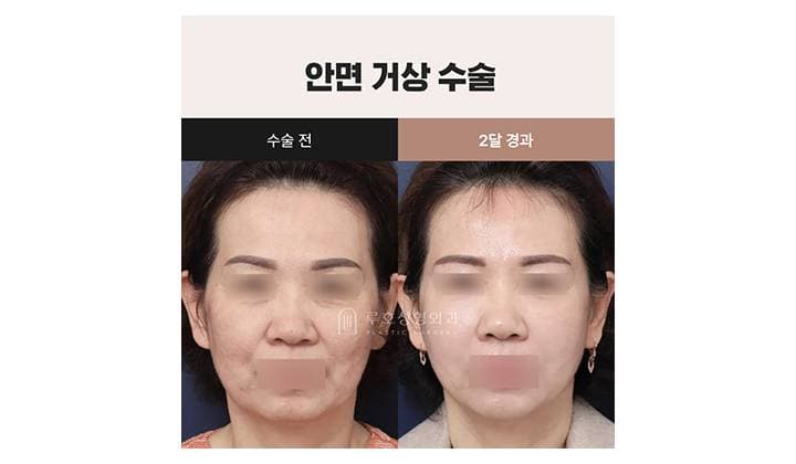 신사역 안면거상 성형외과 : 심부볼 처짐 개선한 케이스