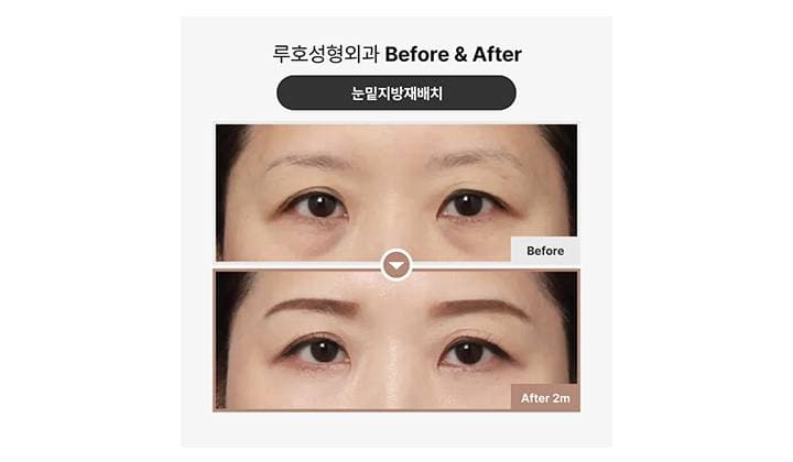 신사역 눈밑지방재배치 후기 : 눈밑볼록 해결한 전후