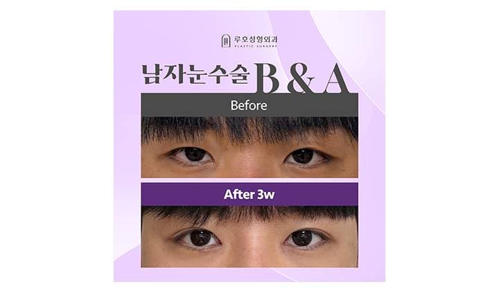 어울리는 눈매를 찾은 강남 신사역 남자눈수술