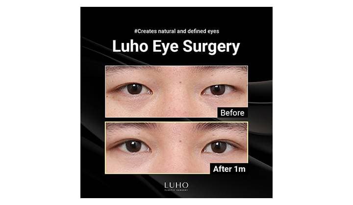 Best eye surgery clinic in Sinsa — key points behind a refined eye shape