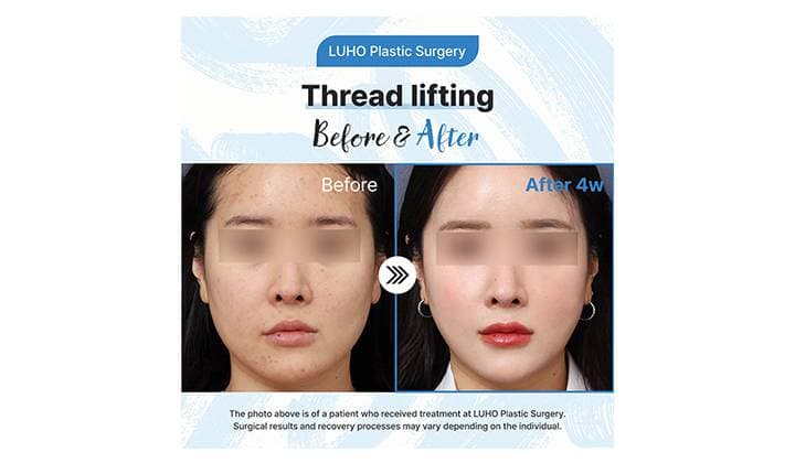 Before & After Lower Face Thread Lift at Sinsa Station
