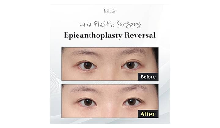 Sinsa epicanthoplasty revision review creating naturally balanced eyes