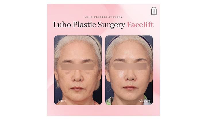 Facelift case in Sinsa restoring weakened midface support
