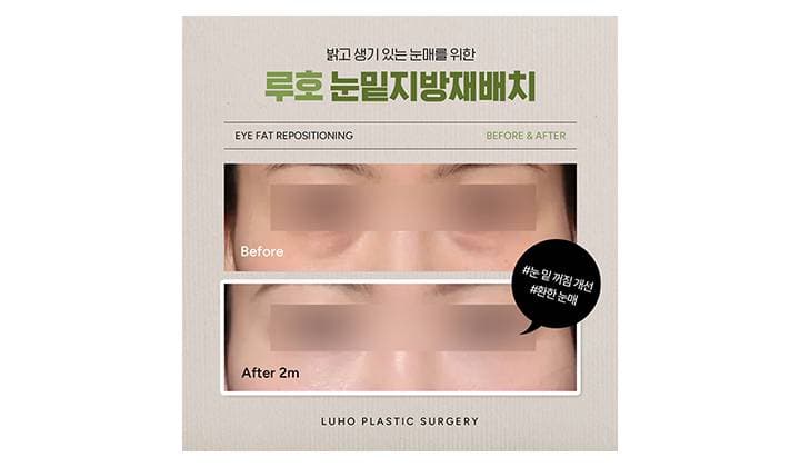 눈밑을 환하게 개선한 신사역 눈밑지 전후 비교