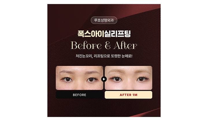 눈꼬리를 교정하여 이미지가 달라진 신사역 폭스아이실리프팅 후기