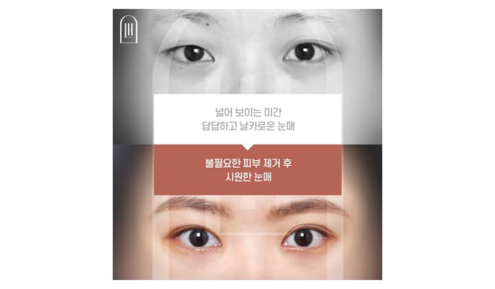 앞트임 흉터, 복원으로 개선이 가능할까요?