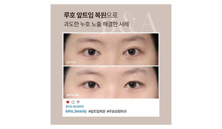 과도한 누호 노출 개선한 신사역 앞트임 복원 사례