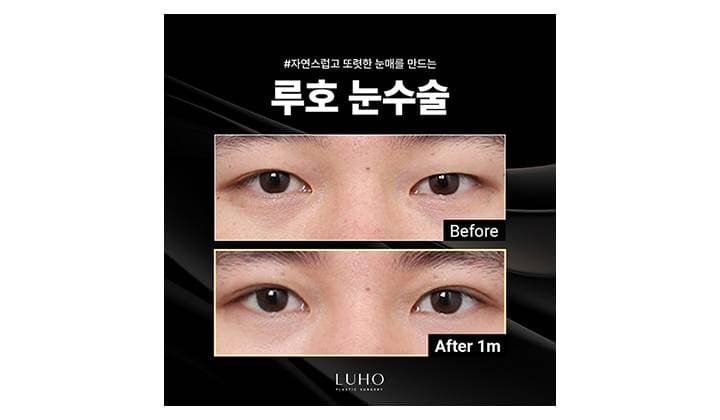 신사역 눈수술 잘하는 곳, 눈매를 개선한 포인트