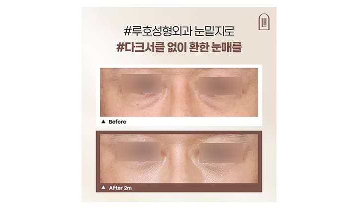 신사역 눈밑지방재배치로 남자 다크서클 해결한 사례