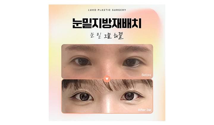 눈 밑 그늘 해결하는 눈밑지방재배치 후기
