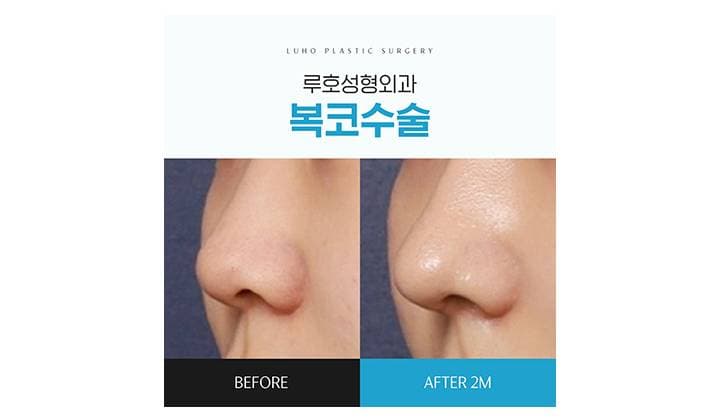 강남 신사역 복코수술로 원하는 라인을 만든 모습