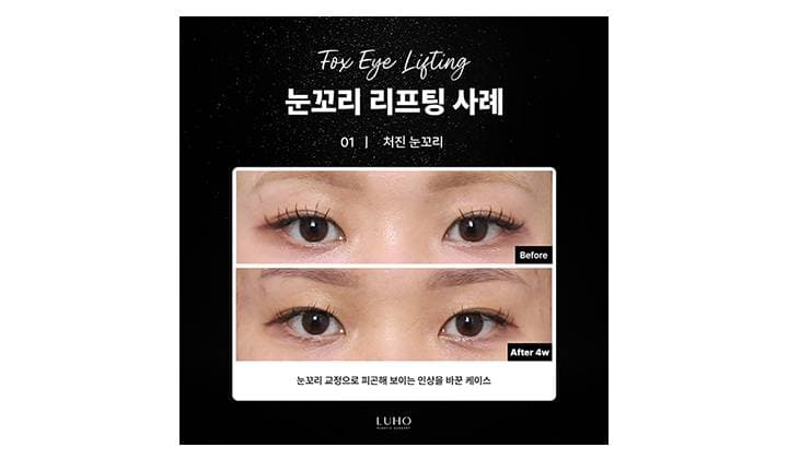 눈매 가로 확장으로 또렷해진 신사역 눈꼬리 올린 후 모습