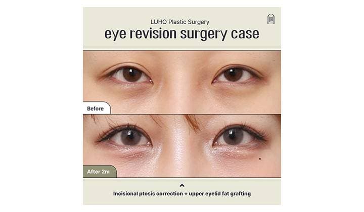 Revisiting Brighter, More Defined Eyes with Revision Eyelid Surgery in Sinsa