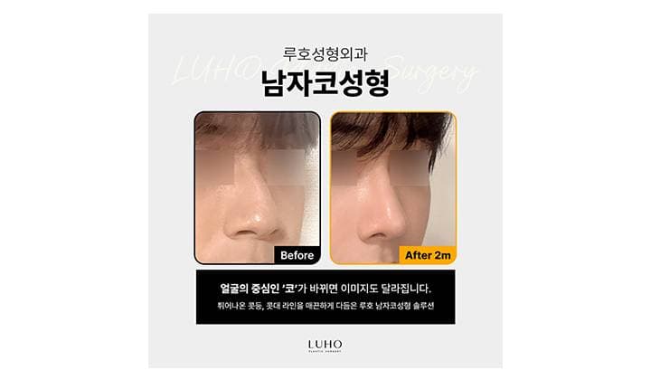 얼굴과 잘 어우러지는 라인을 만들어 낸 남자 코성형 전후 비교