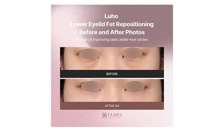 Under-Eye Fat Repositioning for Dark Circles | Before & After Results