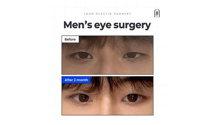 Male Asymmetrical Eye Surgery Near Gangnam and Sinsa Station