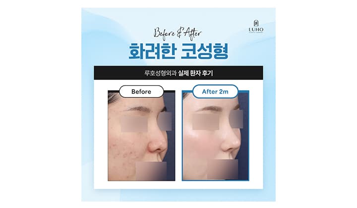 개방형 vs 비개방형 코 수술 차이점 알아보기