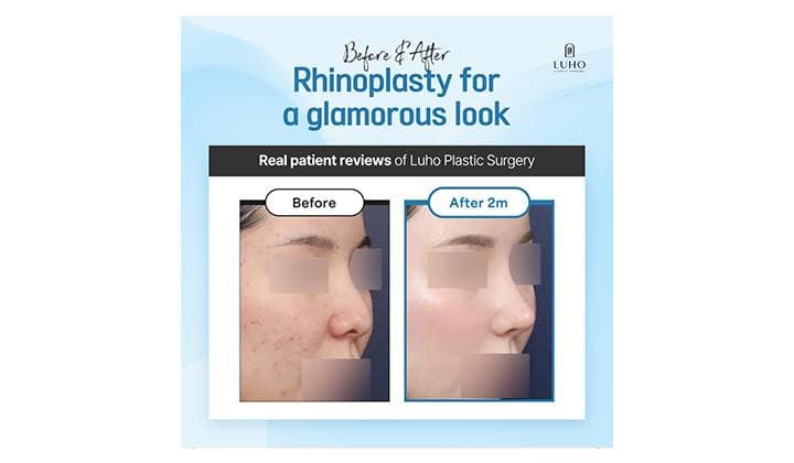 Open vs. Closed Rhinoplasty: Understanding the Key Differences