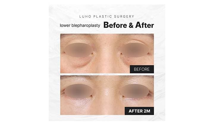 Lower Eyelid Surgery in Gangnam Sinsa for Heavy-Looking Under-Eyes