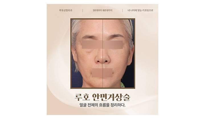 얼굴 전체 흐름을 정리한 신사역 안면거상술 후기