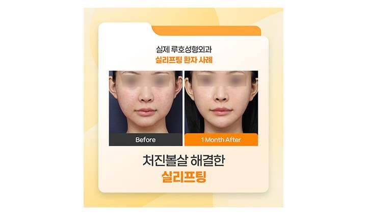 처진볼살 해결한 신사역 실리프팅 후기