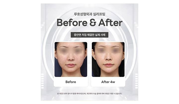 중안면 처짐 사라진 신사역 실리프팅 전후 알아보기