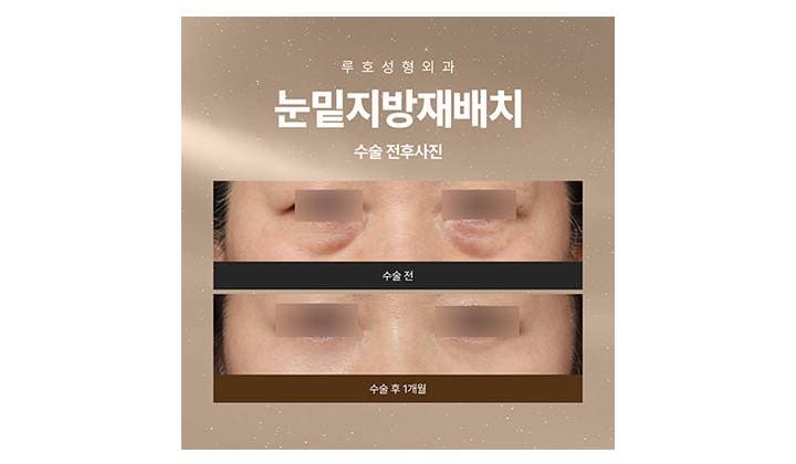 루호성형외과 눈밑지방재배치로 달라진 인상 살펴보기