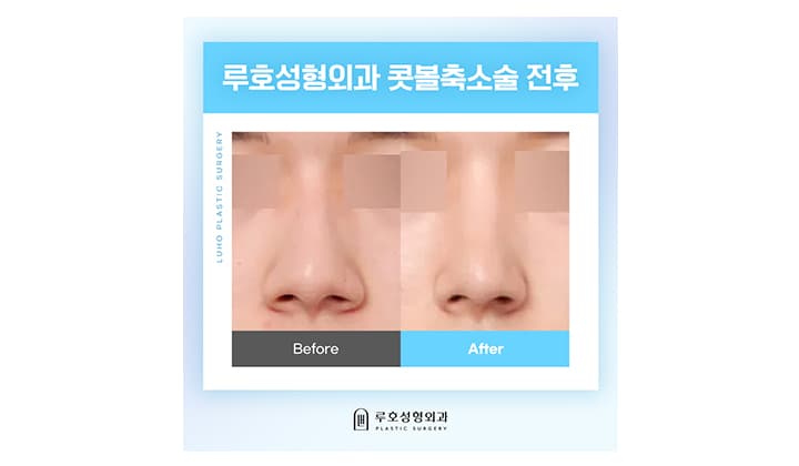 퍼진 인상에서 세련된 이미지 만들어주는 콧볼축소술