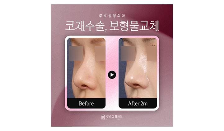보형물 교체를 통한 인위적인 콧대 개선, 신사역 코성형 재수술