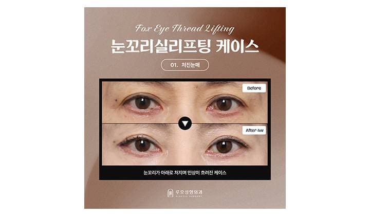 처진 눈매 흐름을 바꿔 놓은 신사역 눈꼬리 실리프팅