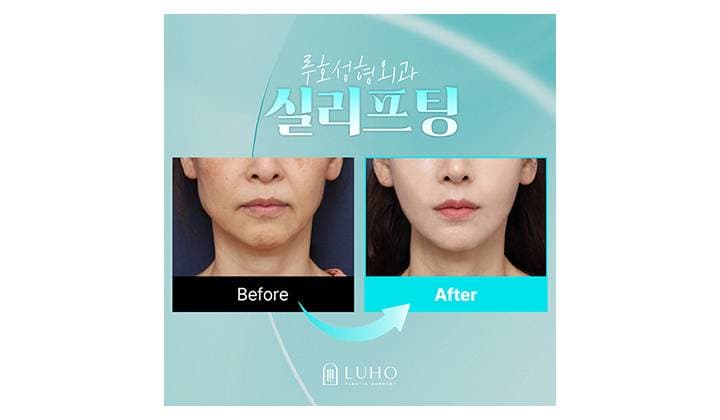늘어진 하안면을 바꿔준 신사역 실리프팅 사례