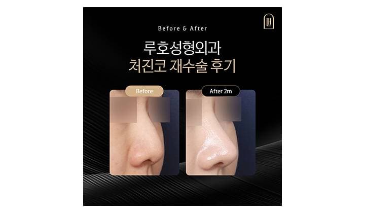신사역 처진 코재수술을 통해 자려한 코로 거듭난 후기