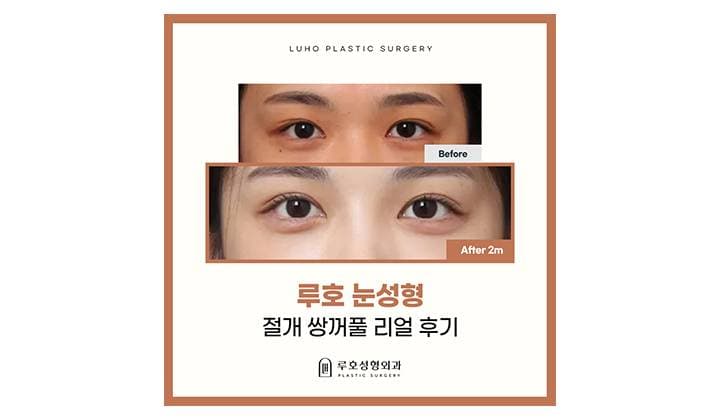 절개 쌍꺼풀 리얼 후기, 신사역 눈성형외과