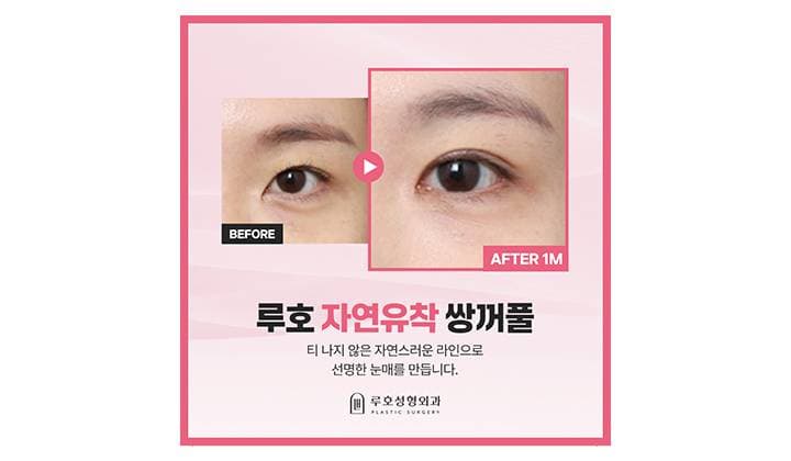 신사역 자연유착쌍수로 흐릿한 눈매 달라진 전후