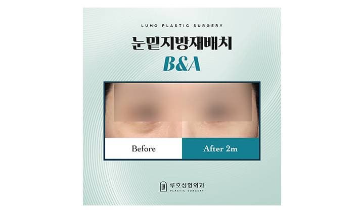 눈밑과 앞볼 경계가 만드는 그늘, 강남 신사역 다크서클 눈밑지로 완화하기