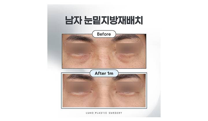 강남 신사역 남자 눈밑지로 다크서클을 정리하고 생기가 더해진 효과