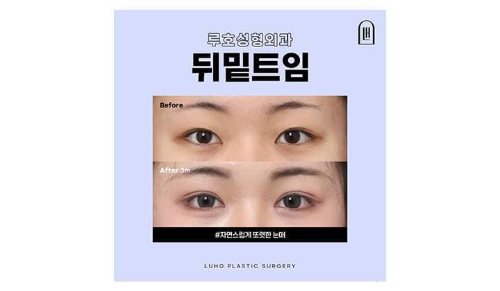 신사역 뒤밑트임으로 답답한 눈매 개선한 사례