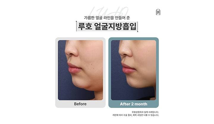 강남 신사역 얼굴지방흡입으로 달라진 모습 살펴보기