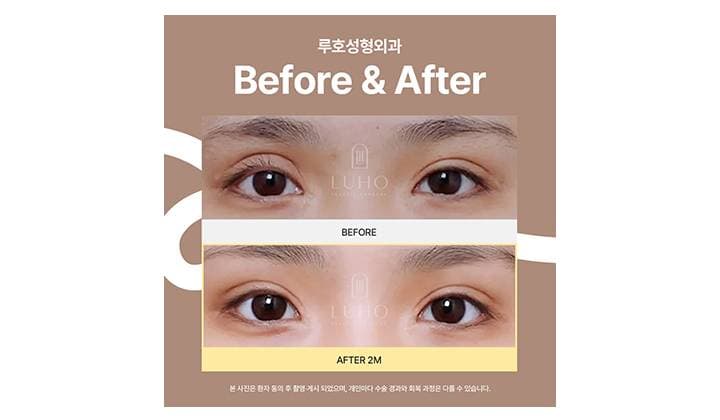 과교정 쌍꺼풀 라인, 눈재수술로 개선 된 케이스