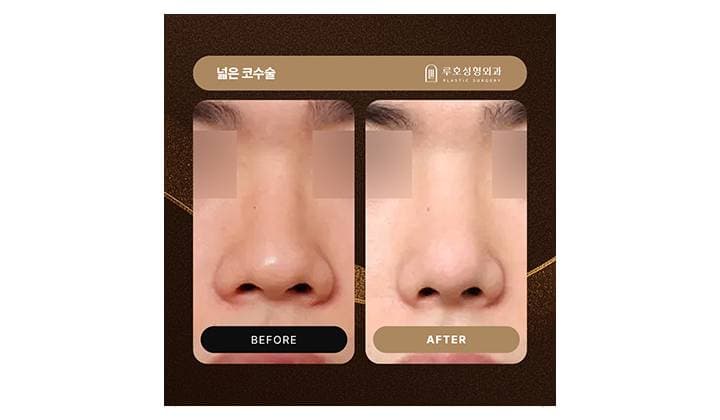 신사역 넓은코수술, 콧대 교정으로 중심선 정리