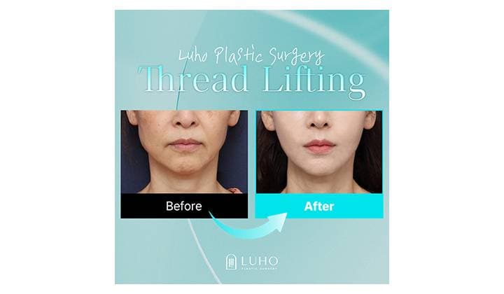 Thread lifting case in Sinsa improving sagging lower face