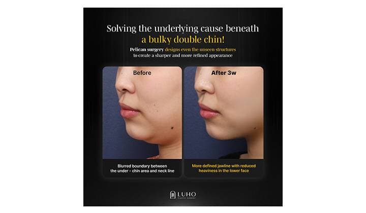 A Smoother Jawline After Double Chin Surgery in Sinsa Gangnam