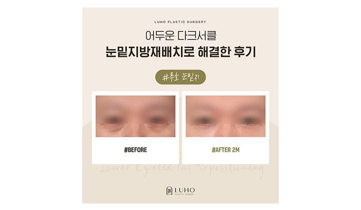 강남 신사역 눈밑지 성형외과, 눈밑 다크서클 해결한 방법