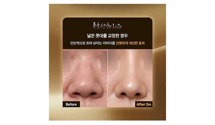 넓은 콧대를 교정하여 라인을 바꾼 신사역 코수술 전후