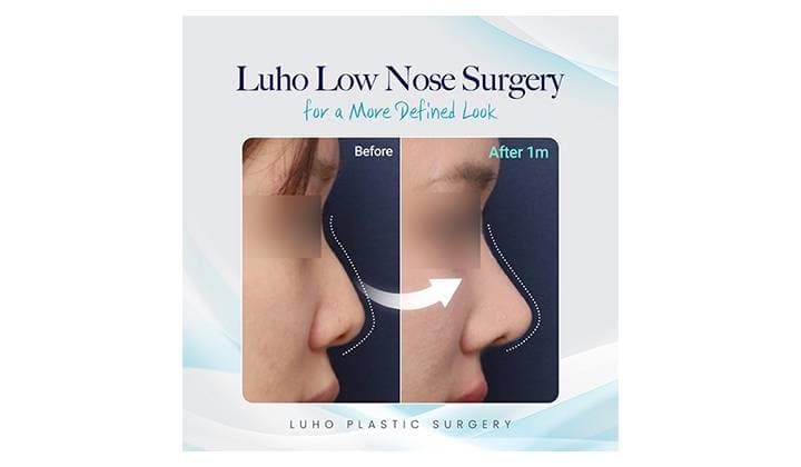 Sinsa low nose surgery review transforming a flat appearance into a refined profile