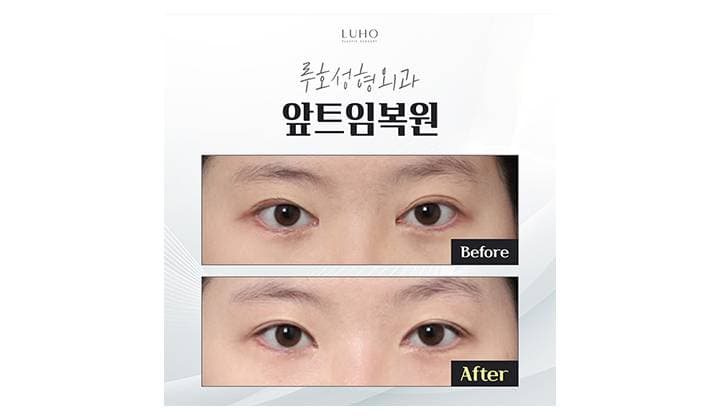 자연스럽게 어울리는 눈매를 완성한 신사역 앞트임 복원 후기
