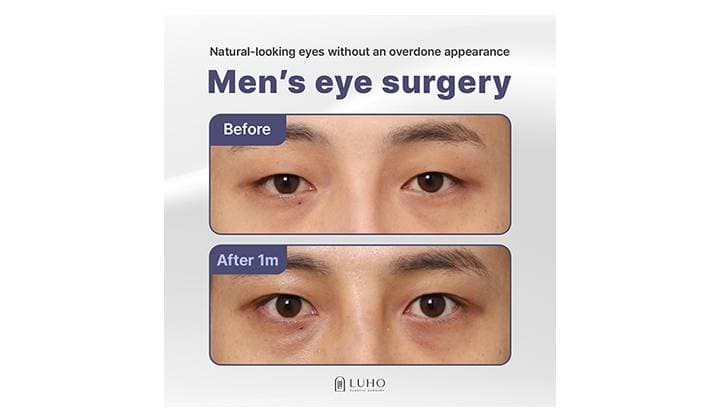 Male Eyelid Surgery in Gangnam: A Natural, More Open Look